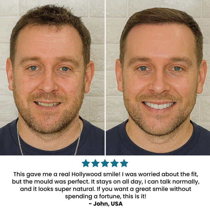 SecureSmile - Achieve a Flawless Smile Instantly - 50% OFF