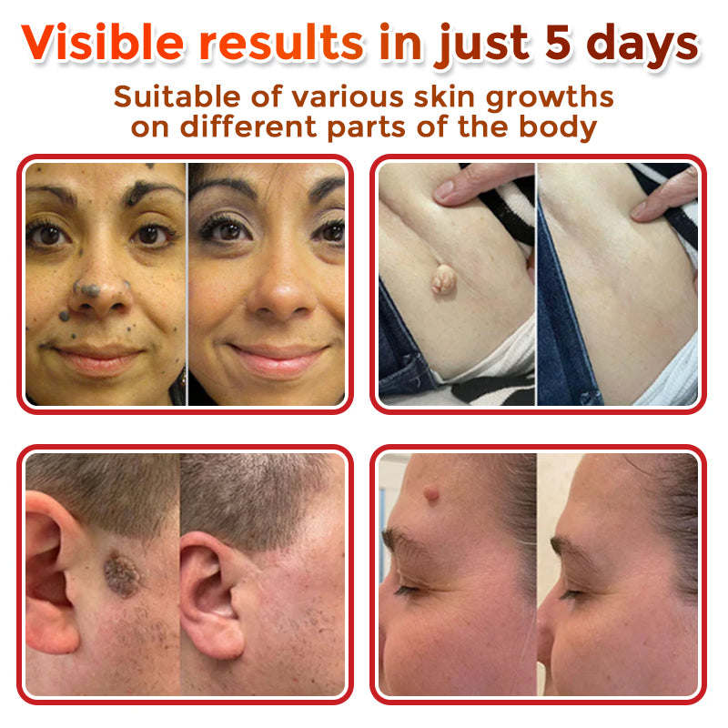 The MicroDerm Patch - Painless Skin Tag & Blemish Removal + 50% OFF