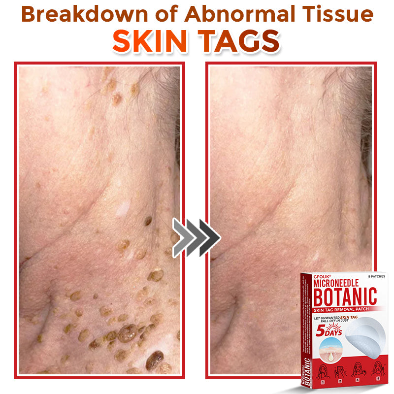 The MicroDerm Patch - Painless Skin Tag & Blemish Removal + 50% OFF